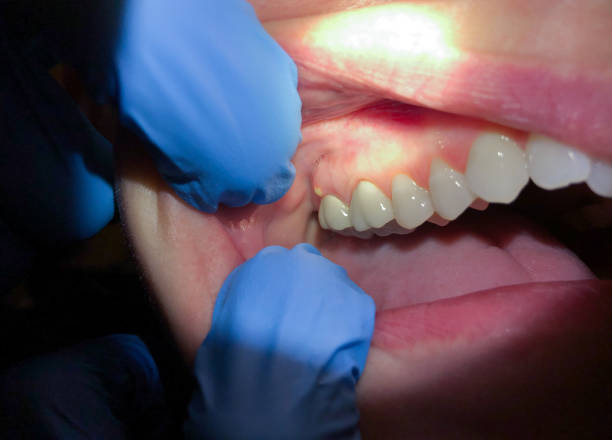 Best Emergency Dental Care for Abscessed Tooth in Crown Pot, IN